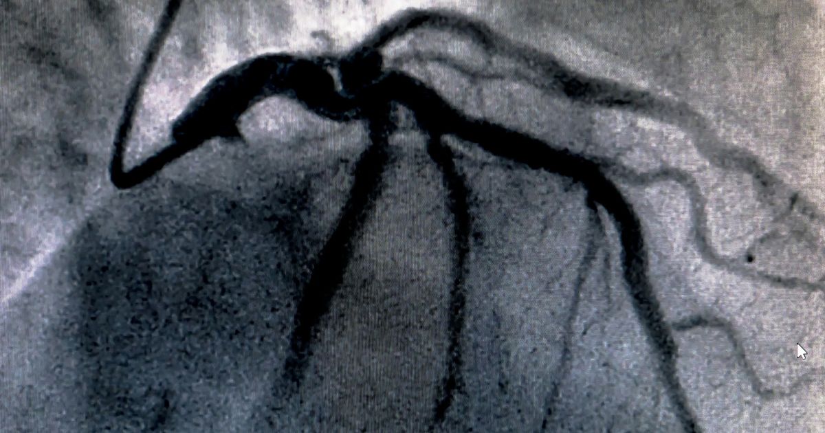 Κοιλιογραφία