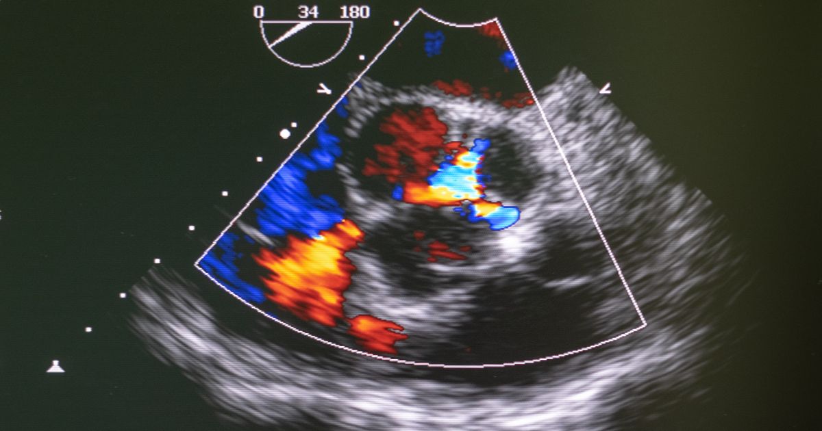 Τρίπλεξ Καρδιάς