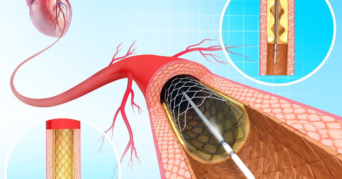 δεξιός καθετηριασμός