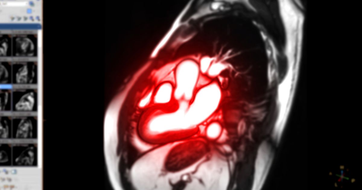 μαγνητική καρδιάς